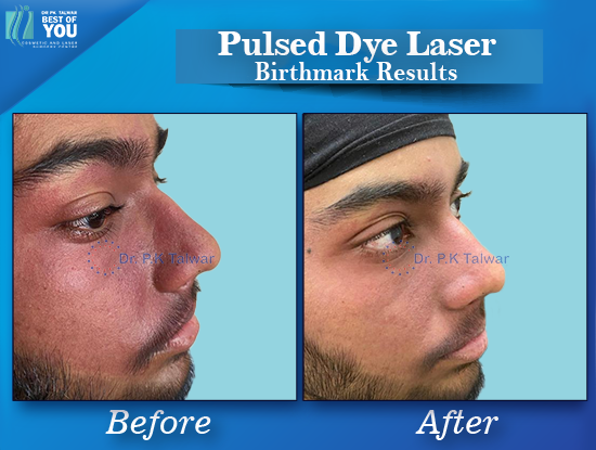 Pulsed Dye Laser Result